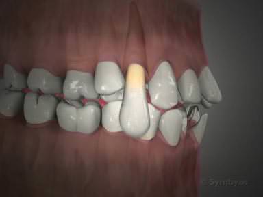 simple-tooth-extractions-toothiq-384