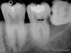 Dental periapical X-ray (radiograph) showing tooth decay (caries).
