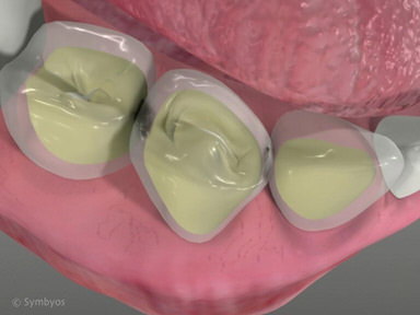 Tooth Decay video