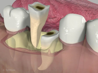 Surgical Tooth Removal video