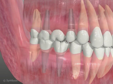 Dental Implants video