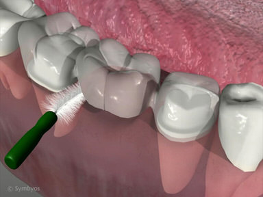 How to Use an Interdental Brush video